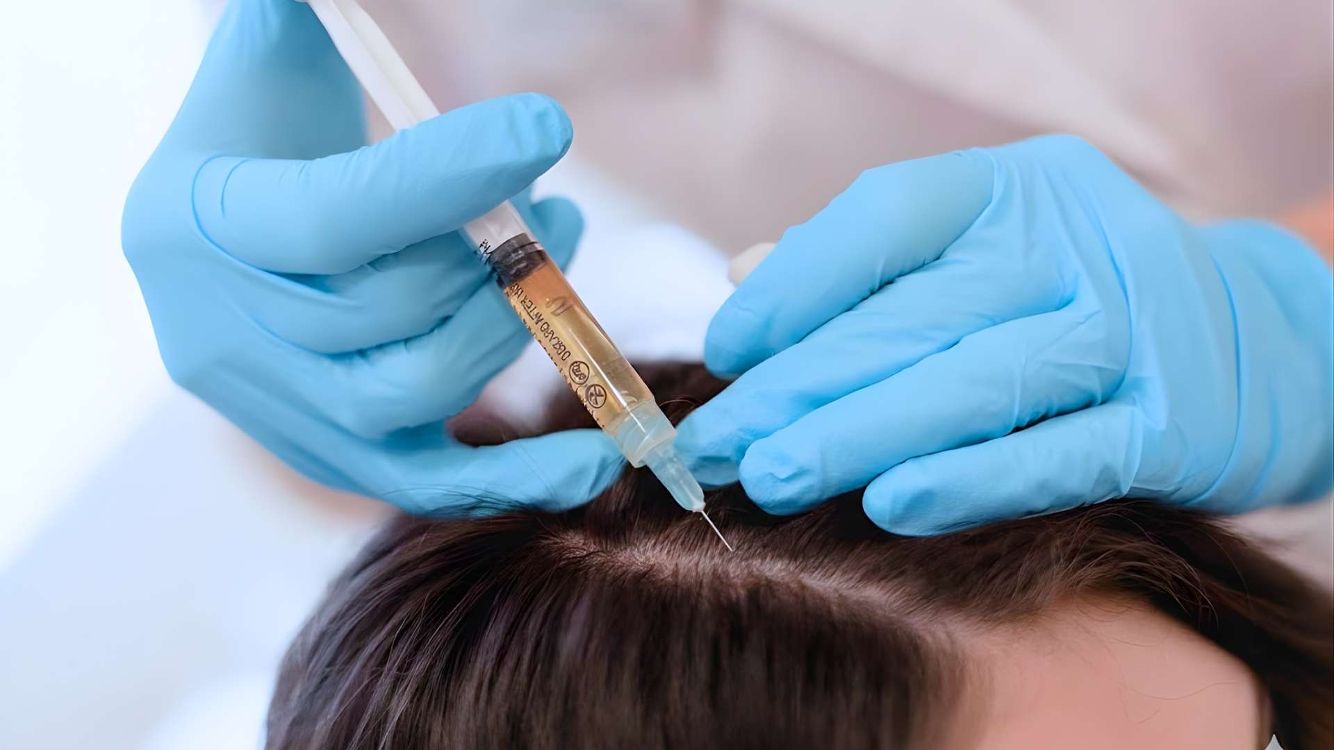 PRP Capilar (Fortalecimiento Anticaída)